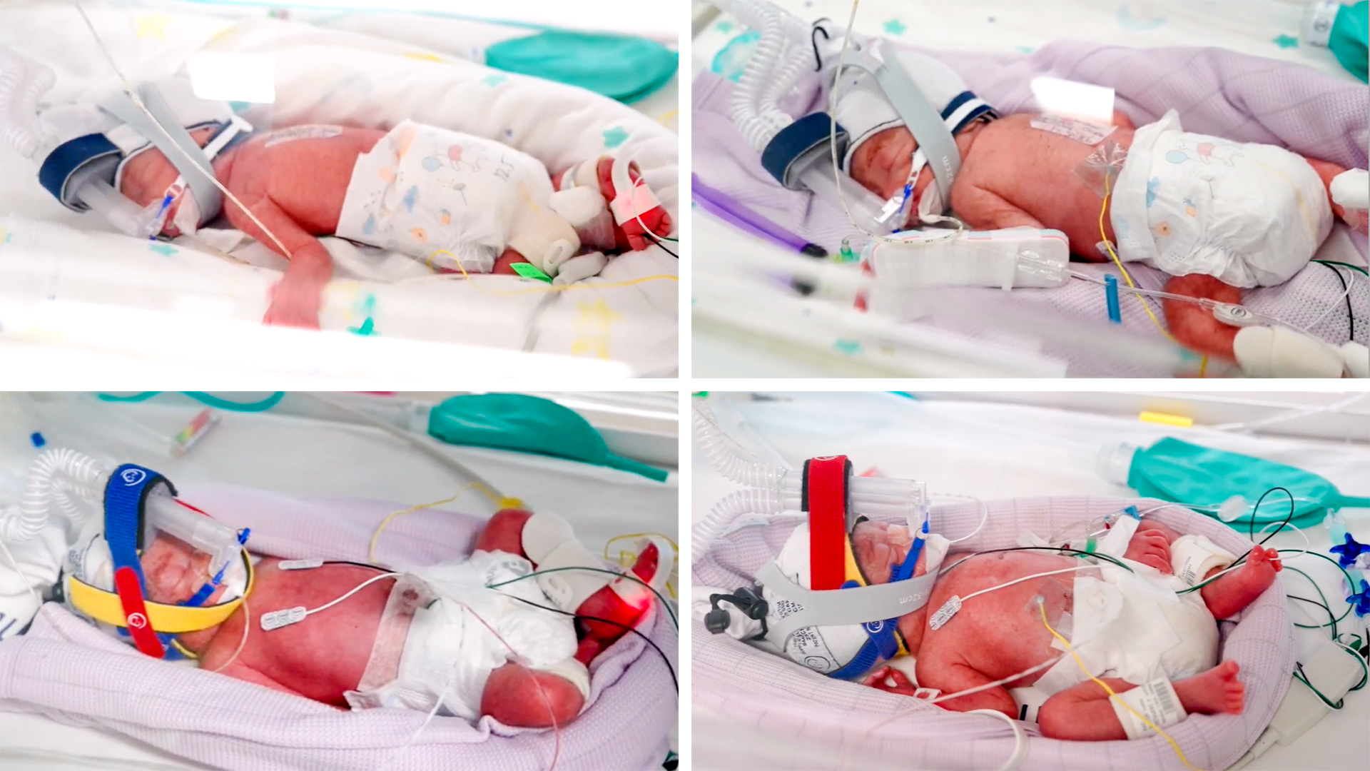 Rare Identical Quadruplets Born in Australia, an Unprecedented Miracle