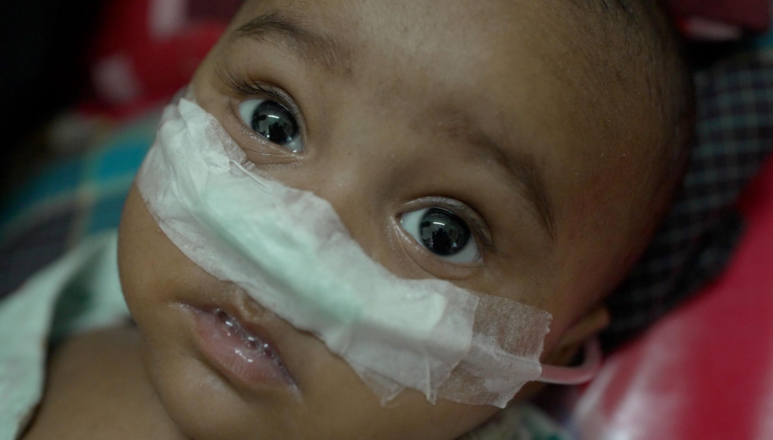 Bangladesh's Measles Outbreak Takes a Deadly Toll