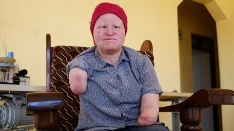 Election Period Brings Distress for Tanzanians with Albinism
